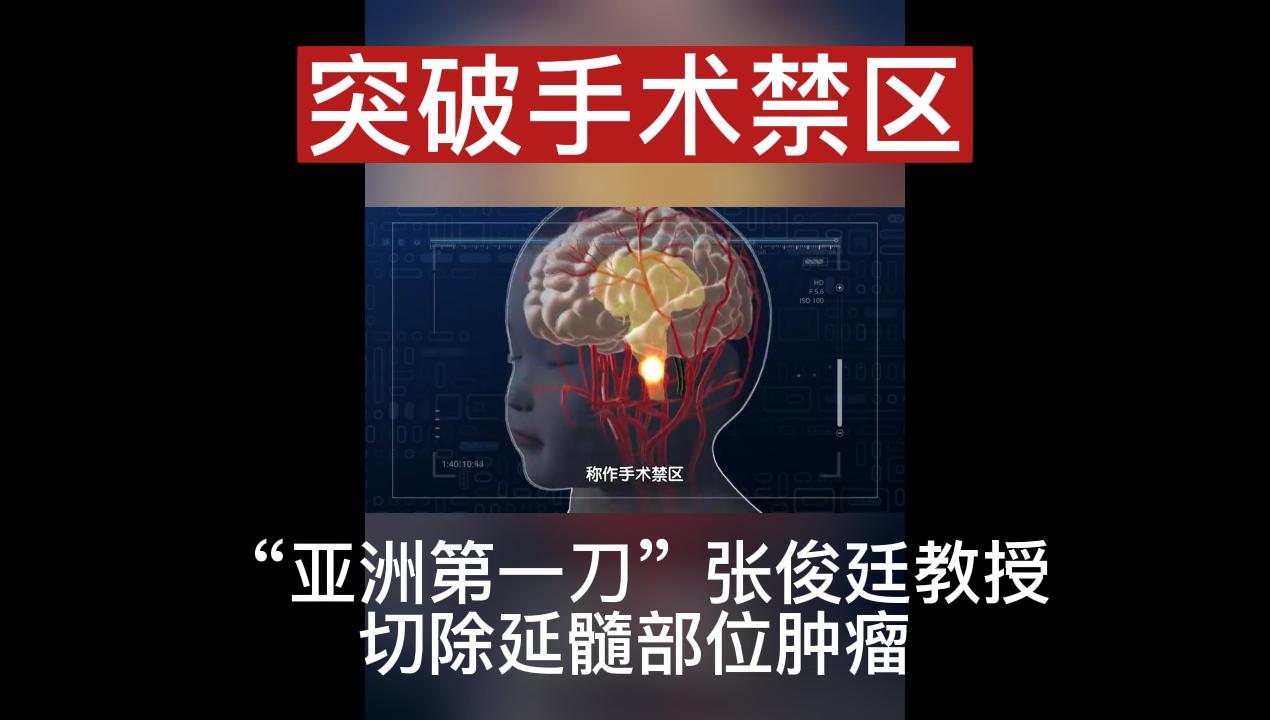“亚洲第一刀”张俊廷教授切除延髓部位肿瘤